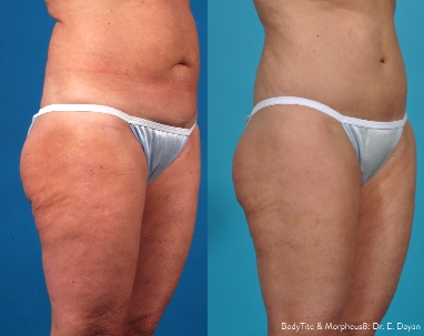 Before & After Benefits of Trusculpt ID and Trubody
