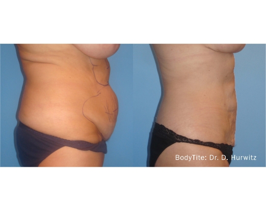 TruBody – TruSculpt ID Before & After