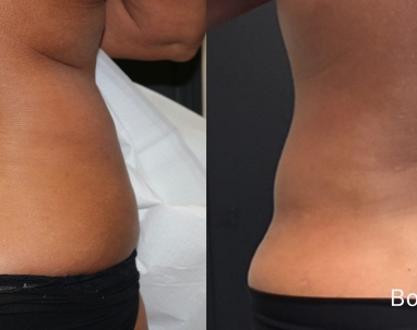 After Trusculpt ID and Trubody