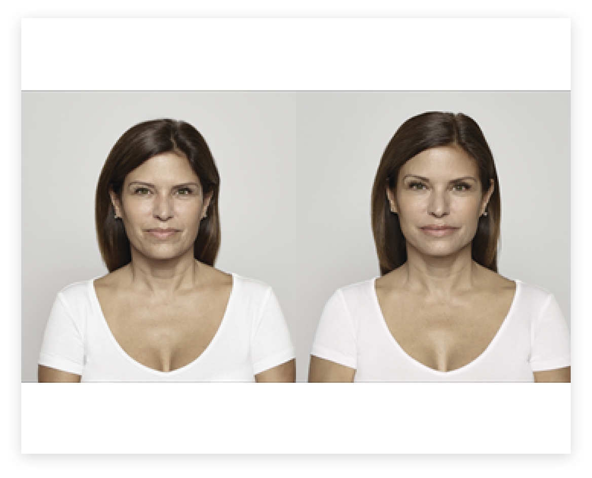 Botox & Fillers Before & After