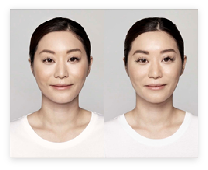 Before & After Advantages of Botox & Fillers