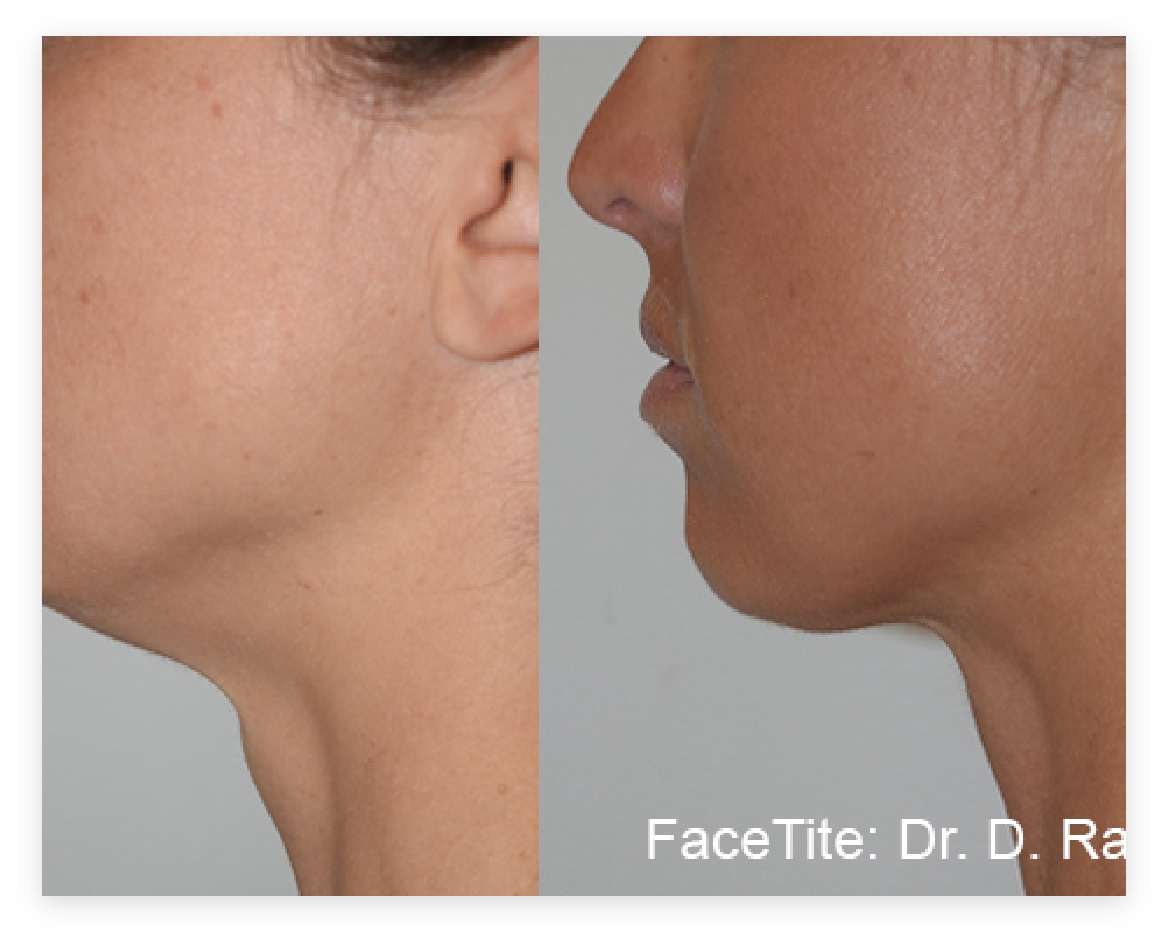 Before and After of facetite before and after