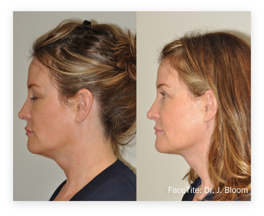 Before and After of facial skin tightening