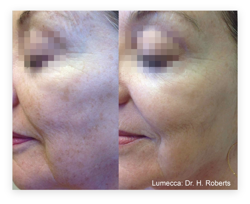 Before & After Benefits of IPL- Photofacial with Lumecca