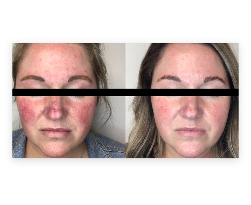 IPL- Photofacial with Lumecca Surgery Before & After