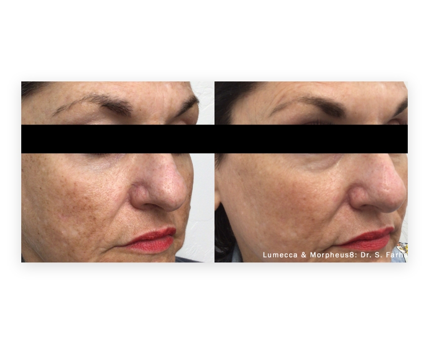 IPL- Photofacial with Lumecca Before & After