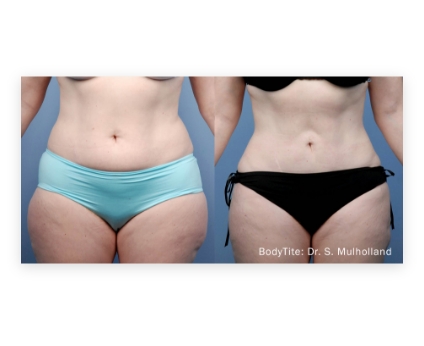 Before and After of bodytite liposuction cost