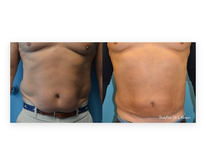 Before and After of bodytite liposuction