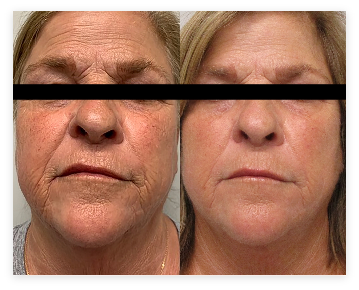 Morpheus 8 and Body Before & After
