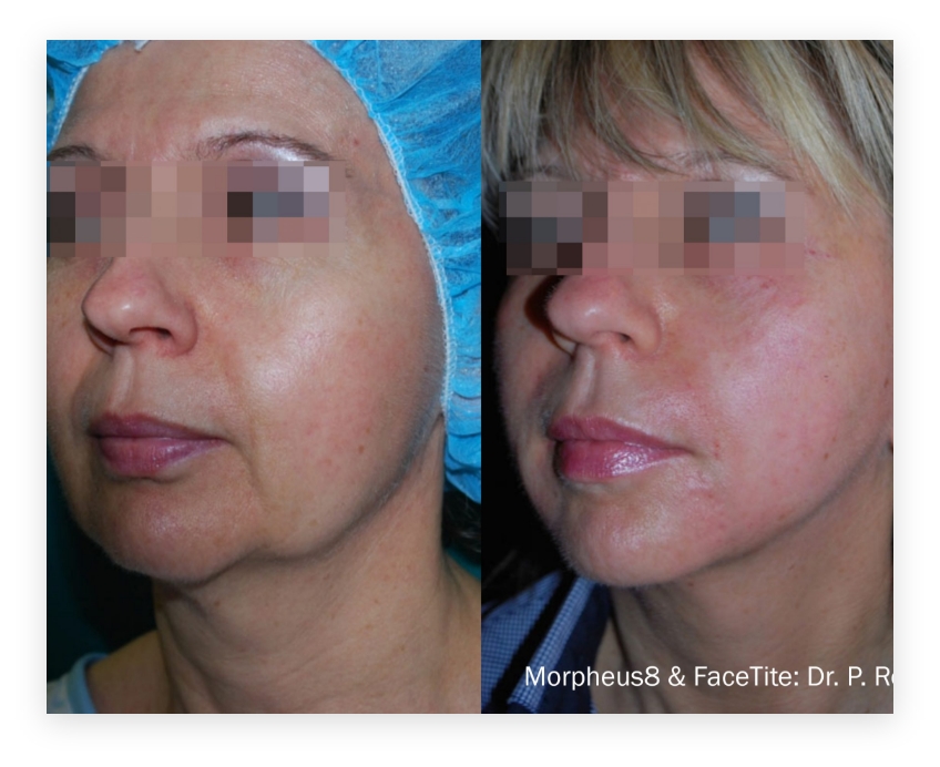 Morpheus 8 Recovery Before & After