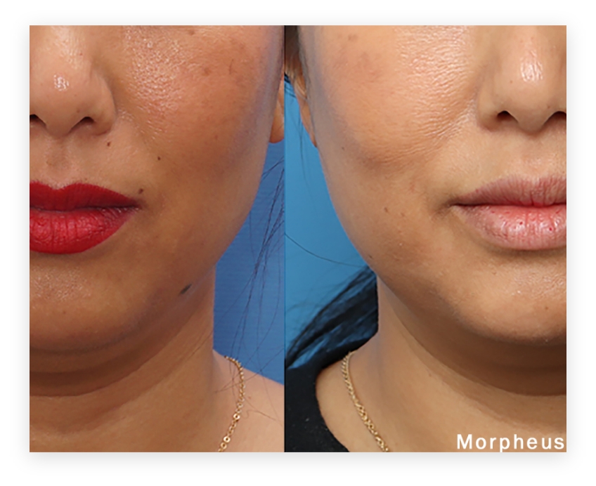 Benefits of Morpheus 8 Before & After