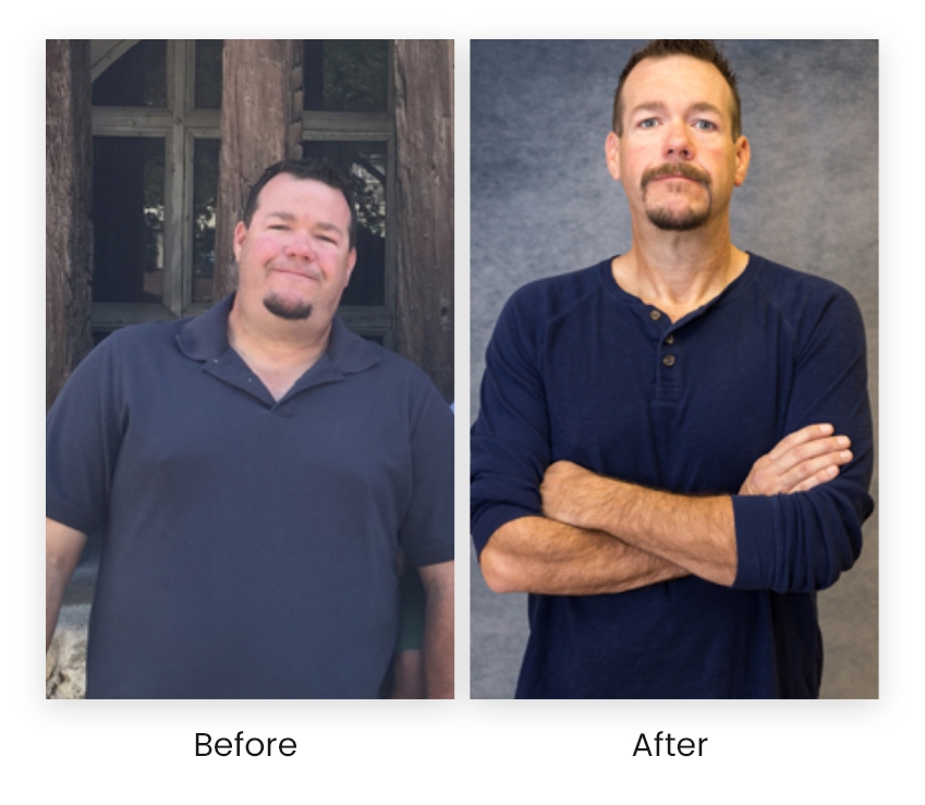 Before and After of weight loss surgery
