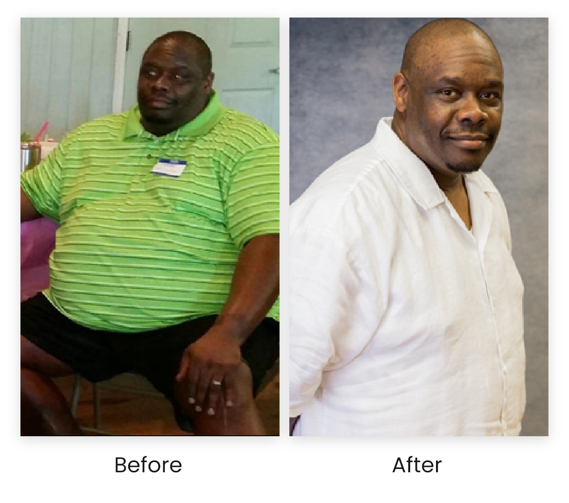 Laser Hair Removal Before & After