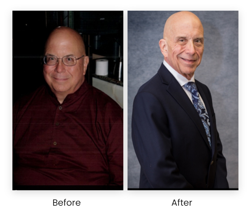 Before & After Advantages of Laser Hair Removal