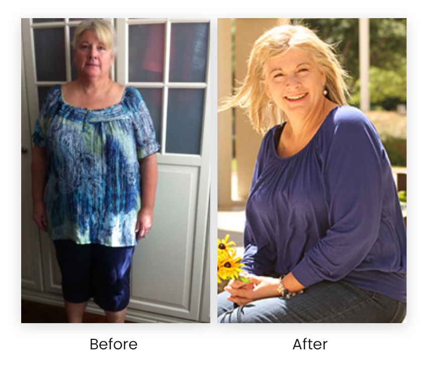 Laser Vein Removal Before & After