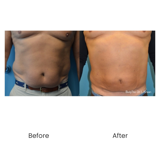TruSculpt Flex Muscle Before & After