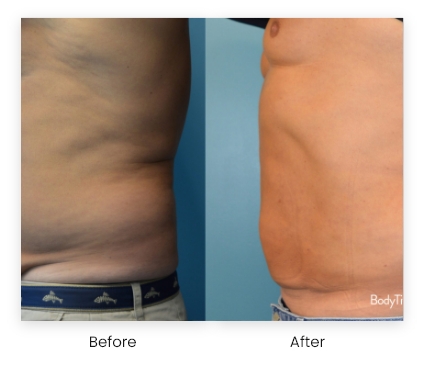 TruSculpt Flex – Muscle Before & After