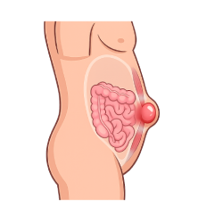 Illustration of the front abdominal wall where a ventral hernia can occur
