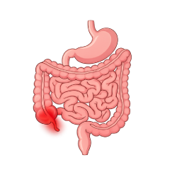 Medical illustration showing the appendix in the lower right abdomen