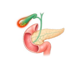 Medical illustration of the gallbladder and gallstones